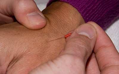 Acupuncture